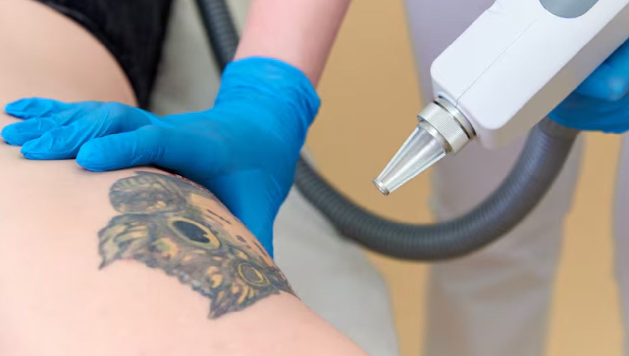 Tattoo Removal